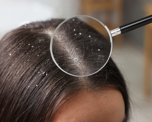 Anti-Dandruff Hair Treatment Mysore